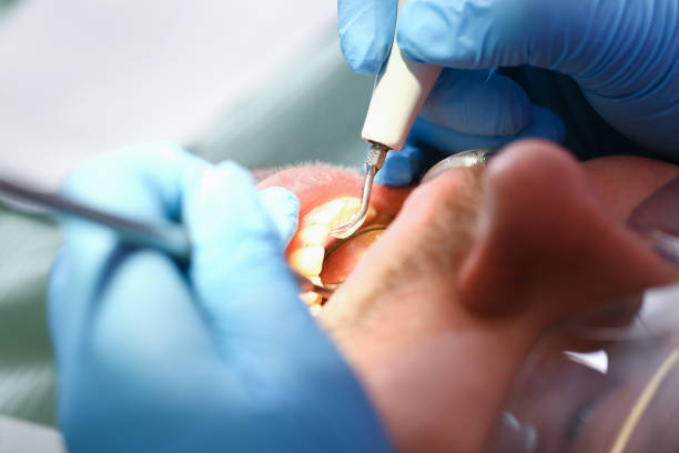 Best Emergency Root Canal Treatment in Newton, KS