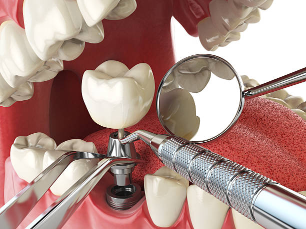 Best Emergency Root Canal Treatment in Newton, KS